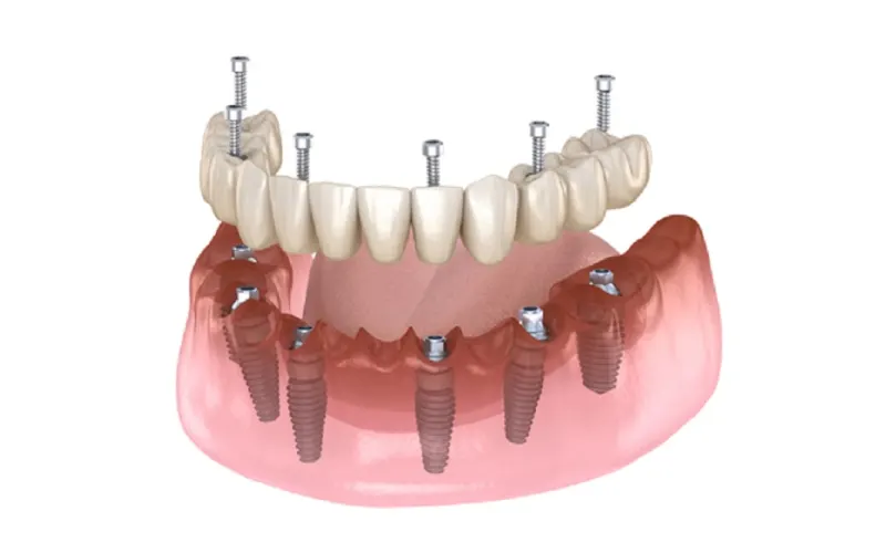 Simulation of the All-on-6 dental implant technique