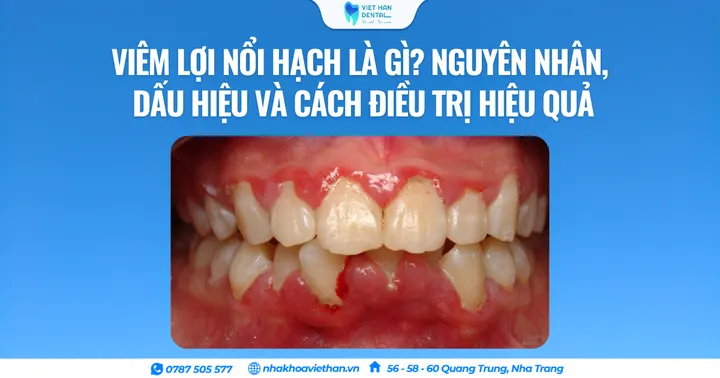 Viêm lợi nổi hạch là gì? Nguyên nhân, dấu hiệu và cách điều trị hiệu quả
