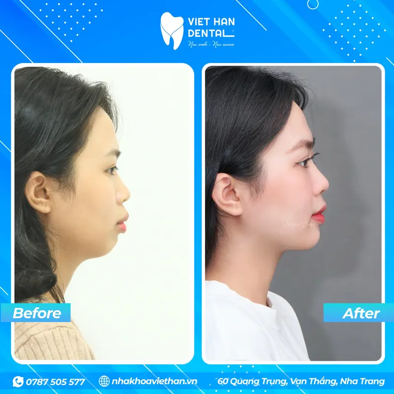 Góc nghiêng của khách hàng trước và sau khi niềng răng tại Nha khoa Việt Hàn