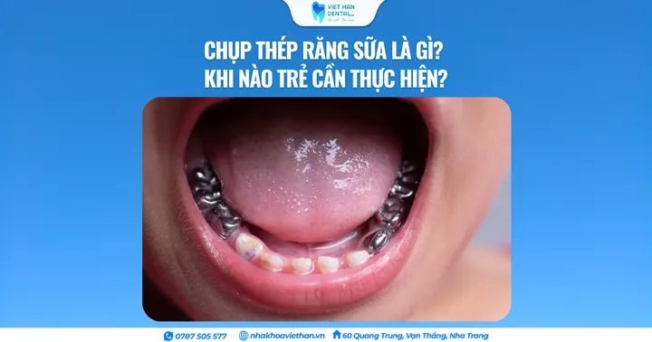 Chụp thép răng sữa là gì? Khi nào trẻ cần thực hiện?