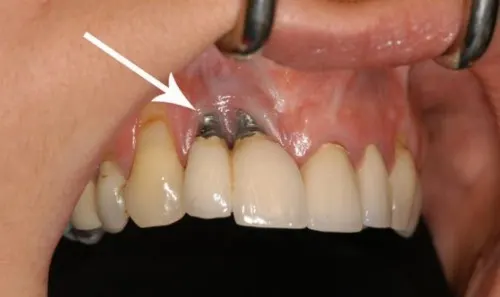 Dental implant rejection
