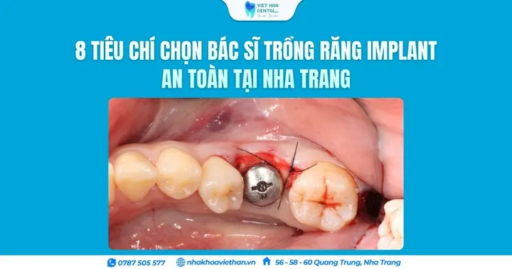 8 Tiêu chí chọn bác sĩ trồng răng Implant an toàn tại Nha Trang