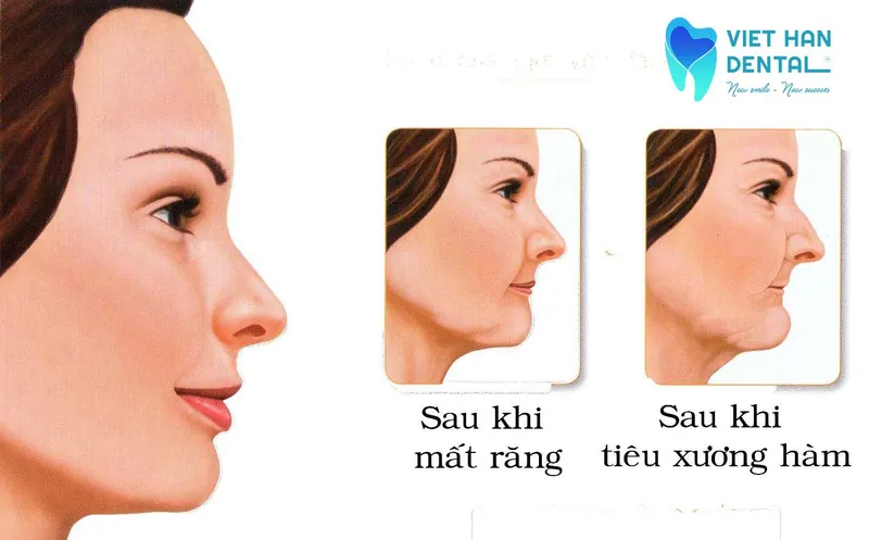 Mất răng dẫn đẩy nhanh quá trình lão hoá 