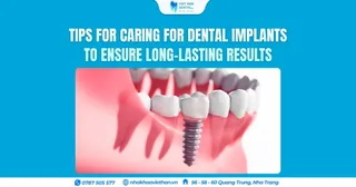 Tips for caring for dental implants to ensure long-lasting results