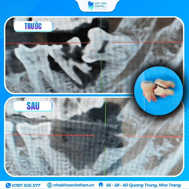 Nhổ răng khôn mọc lệch đâm vào răng số 7