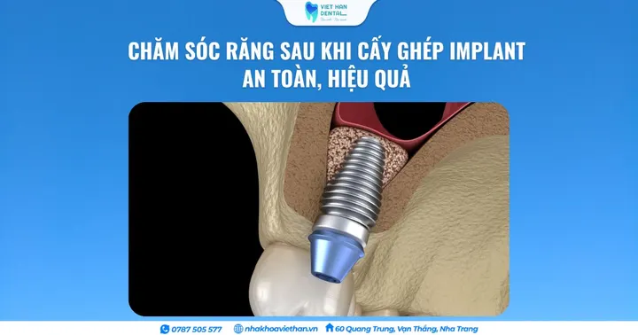 Chăm sóc răng sau khi cấy ghép Implant an toàn, hiệu quả