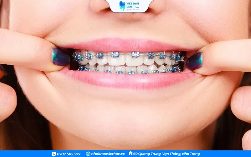 Bung mắc cài hoặc dây cung chọc vào má là những trường hợp thường gặp ở người niềng răng mắc cài