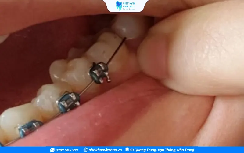 Dây cung niềng răng đâm vào má