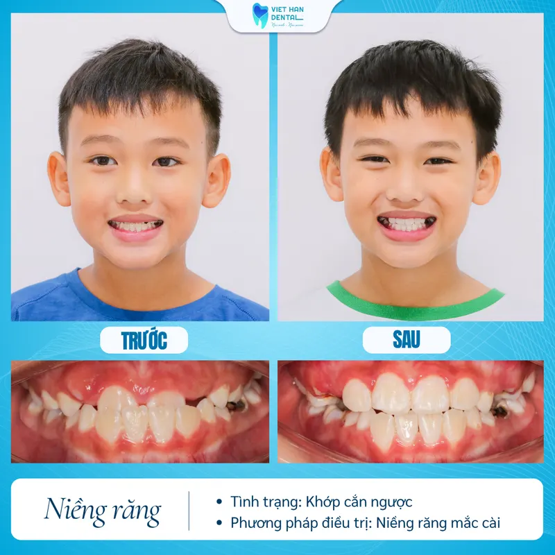 Niềng Răng Tăng Trưởng (1)