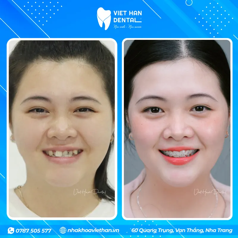 Khách hàng trước và trong quá trình đeo niềng răng tại Nha khoa Việt Hàn