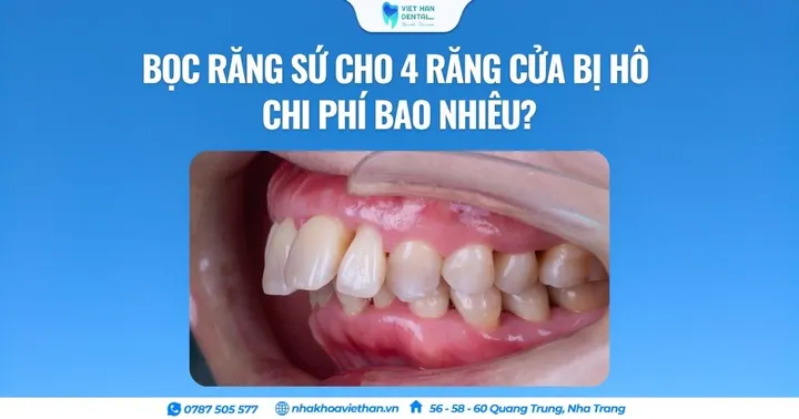 Bọc răng sứ cho 4 răng cửa bị hô chi phí bao nhiêu?