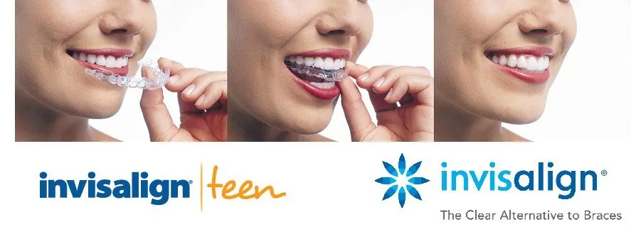 dac-diem-va-quy-trinh-nieng-rang-invisalign