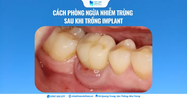 Cách phòng ngừa nhiễm trùng sau khi trồng Implant