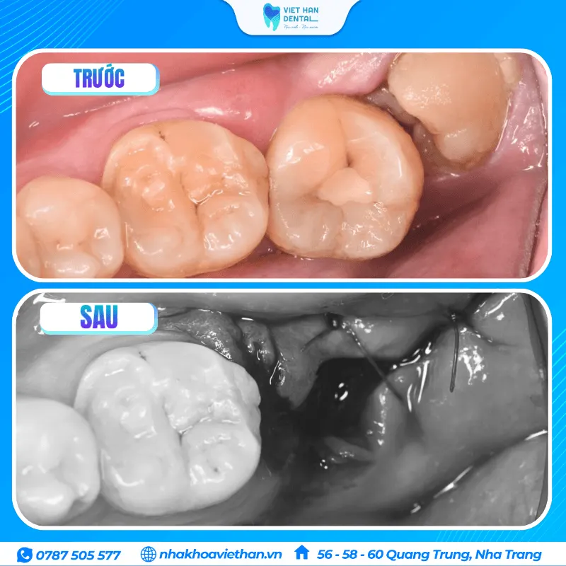 Nhổ răng khôn mọc ngầm gây ảnh hưởng đến răng số 7