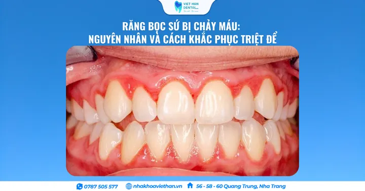 Răng Bọc Sứ Bị Chảy Máu: Nguyên Nhân Và Cách Khắc Phục Triệt Để