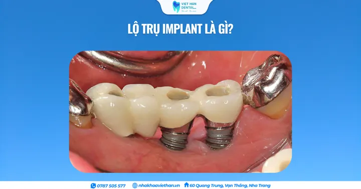 Lộ trụ Implant là gì? Nguyên nhân và cách khắc phục