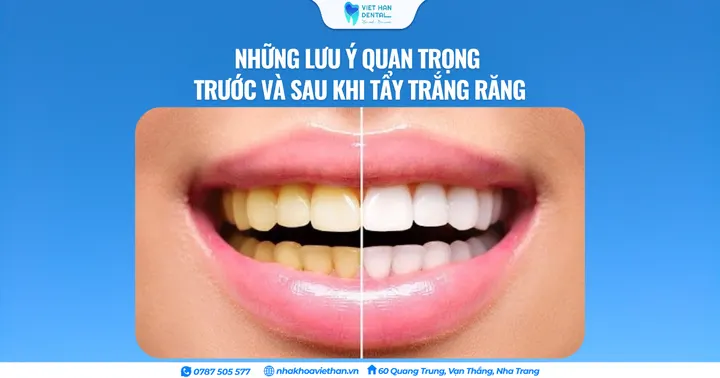 Những lưu ý quan trọng trước và sau khi tẩy trắng răng