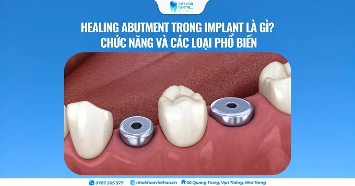 Healing Abutment trong Implant là gì? Chức năng và các loại phổ biến