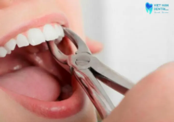 Wisdom tooth extraction