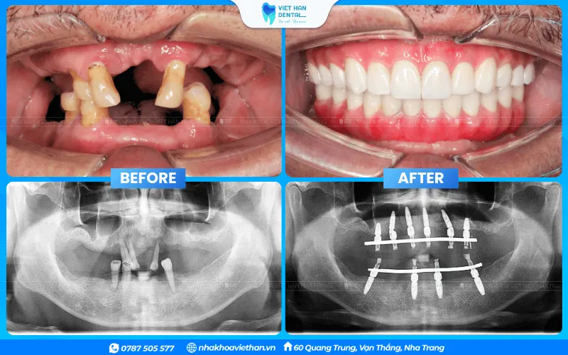 Chú Võ Đức Sử trước và sau khi trồng răng Implant toàn hàm