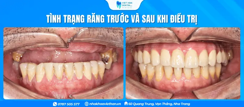 Tình Trạng Răng Trước Khi (1)