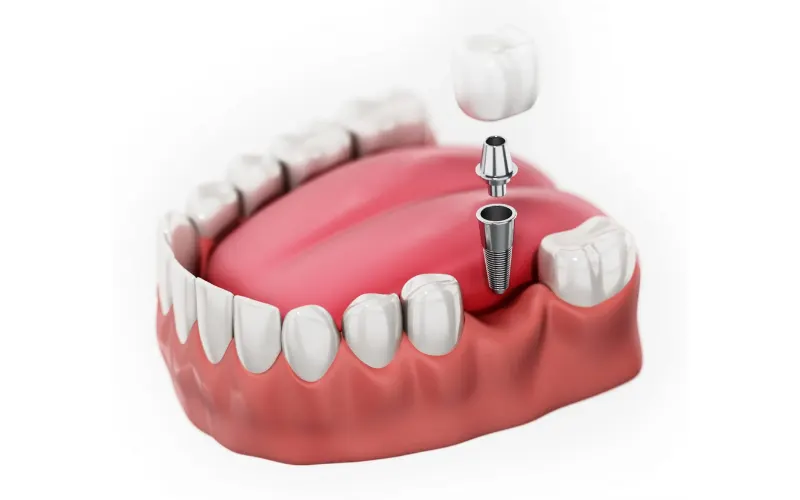 Porcelain crown on an implant