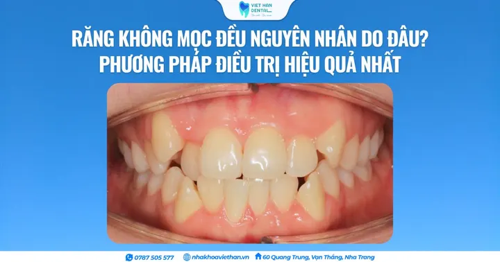 Răng không mọc đều nguyên nhân do đâu? Phương pháp điều trị hiệu quả nhất