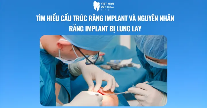 Tìm hiểu cấu trúc răng Implant Và nguyên nhân răng Implant bị lung lay