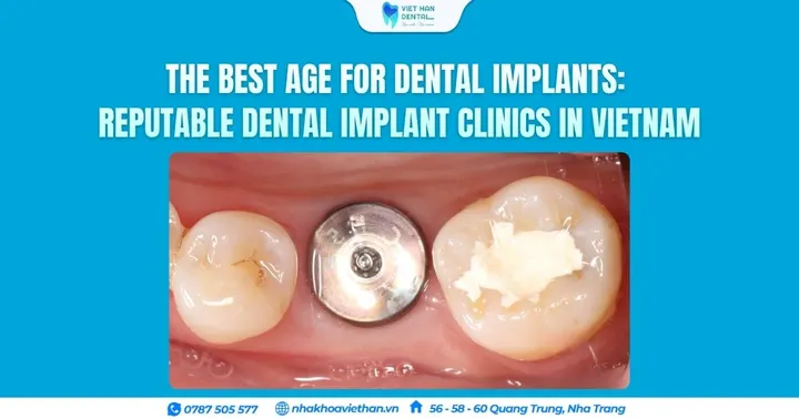 The best age for dental implants: reputable dental implant clinics in Vietnam