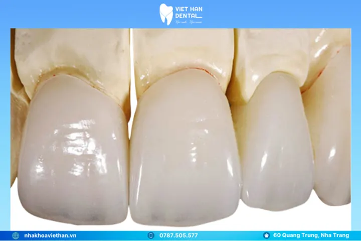 Răng sứ Cercon HT