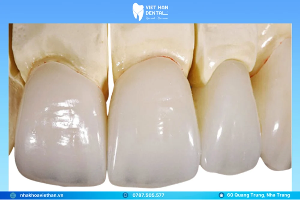 Răng sứ Cercon HT