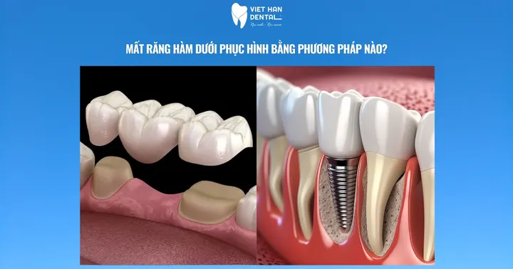 Mất răng hàm dưới phục hình bằng phương pháp nào?