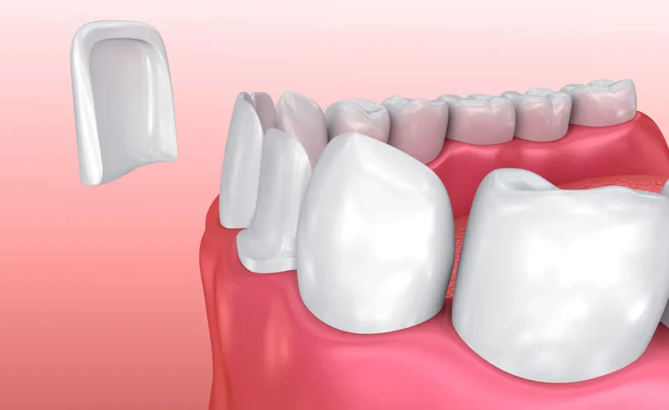  Dental Veneers