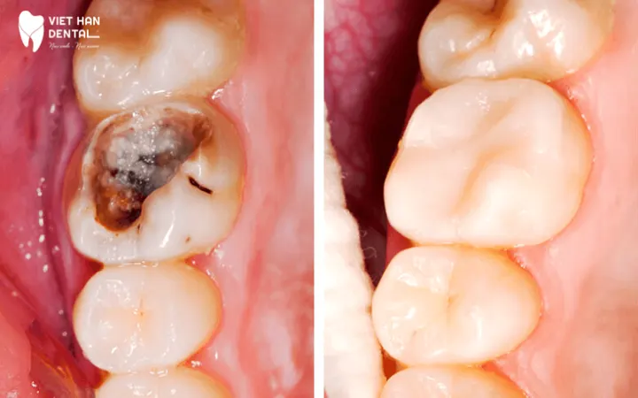 Dental Filling
