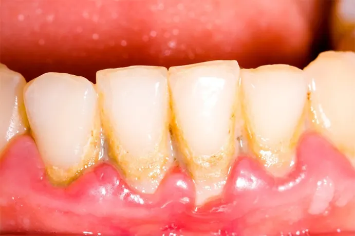Vôi răng&nbsp;được hình thành từ những mảng vụn thức ăn còn dư thừa