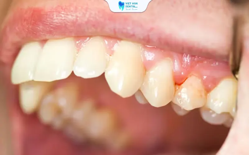 Viêm nướu nguyên nhất mất răng hàng loạt