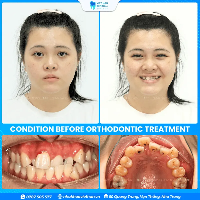 Customer Thuy My before getting braces.