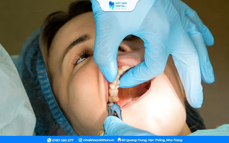 Bác sĩ thường sử dụng công nghệ CT Cone Beam 3D để xác định chính xác vị trí của răng khôn trước khi nhổ