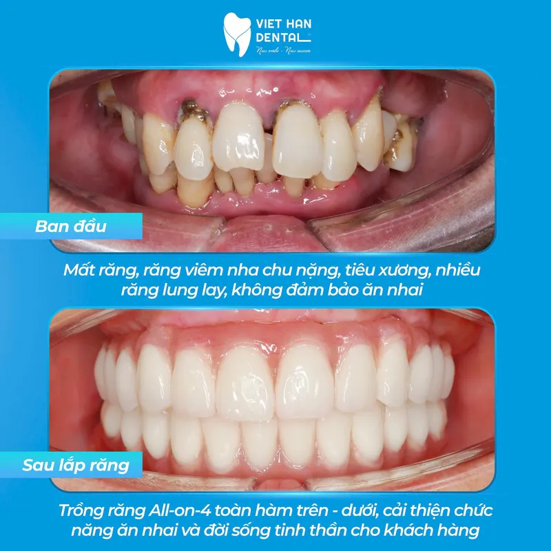 Ngoài Miệng