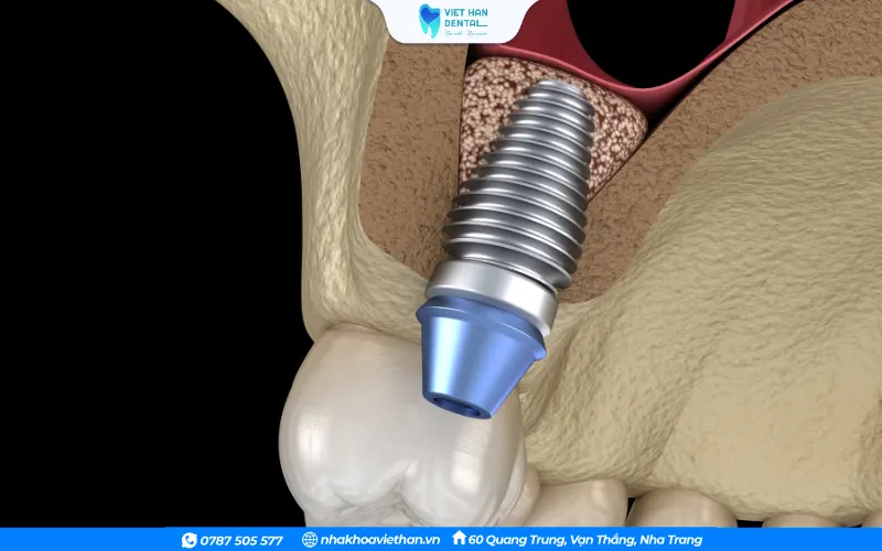 Trồng răng Implant