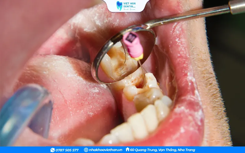 Răng bị sâu nặng, viêm tủy không thể phục hồi