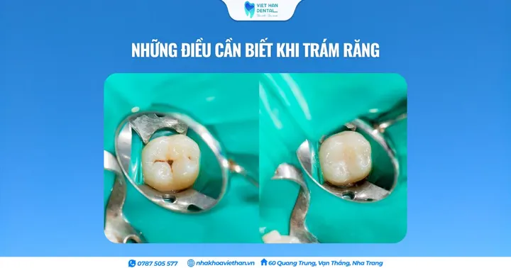 Những điều cần biết khi trám răng
