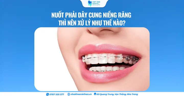 Nuốt phải dây cung niềng răng thì nên xử lý như thế nào?