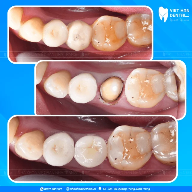 Bọc răng sứ bảo tồn tối đa răng thật của Bác sĩ Văn Thanh Nga