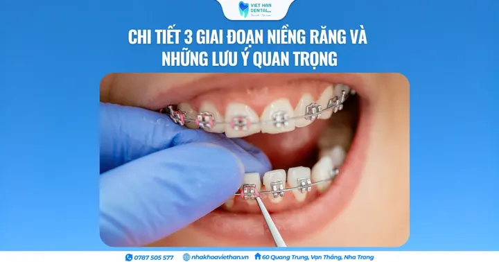 Chi tiết 3 giai đoạn niềng răng và những lưu ý quan trọng