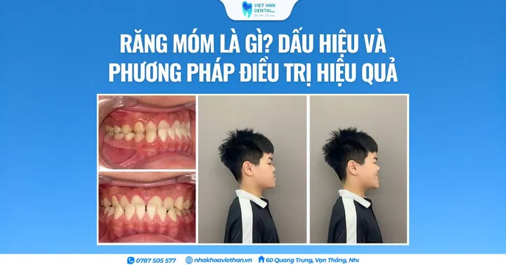 Răng móm là gì? Dấu hiệu và phương pháp điều trị hiệu quả