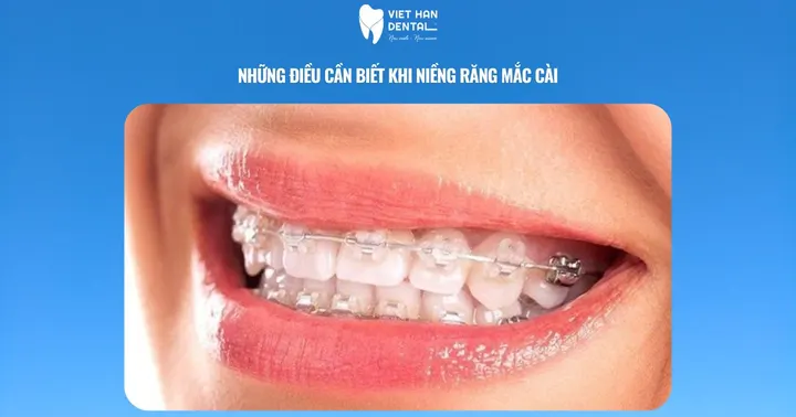 Những điều cần biết khi niềng răng mắc cài