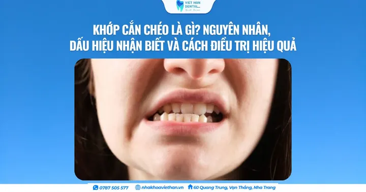 Khớp cắn chéo là gì? Nguyên nhân, dấu hiệu nhận biết và cách điều trị hiệu quả