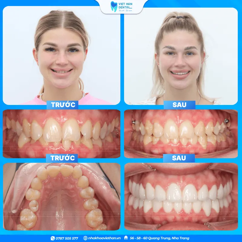 Patients undergoing orthodontic treatment and porcelain veneer placement in Vietnam.
