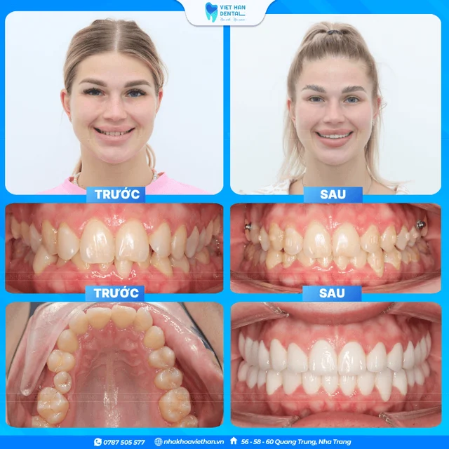 Patients undergoing orthodontic treatment and porcelain veneer placement in Vietnam. của Bác sĩ Hồng Thạnh An